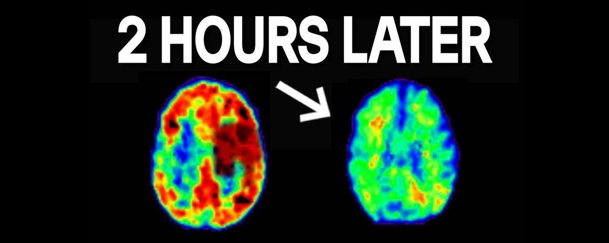 Brain PET scan comparison showing high neural activity on the left and significantly reduced activity two hours later on the right, demonstrating the biological need for recovery